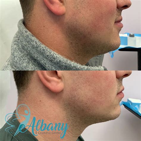 belkyra liverpool|Eliminate Double Chin with Belkyra Injections .